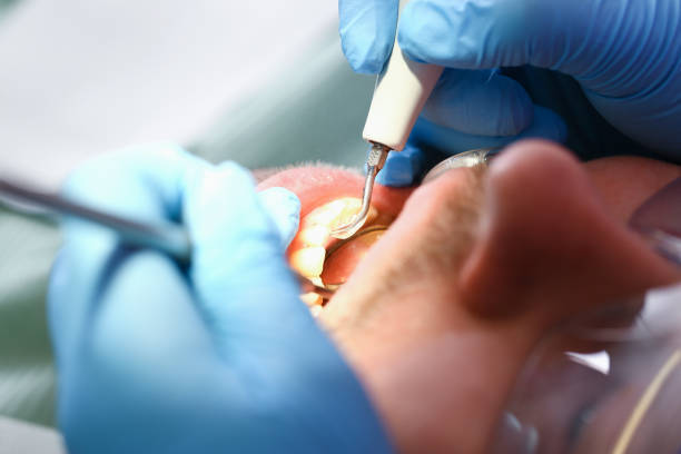 Best Emergency Treatment for Dental Infections or Abscesses in Lmer Heights, PA